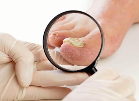 Лечение грибковых заболеваний ногтей